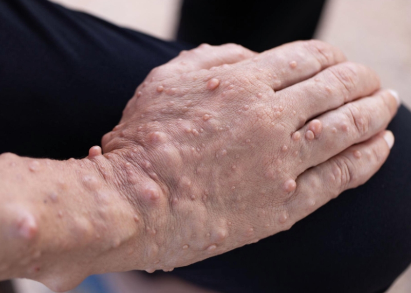 Living-with-neurofibromatosis