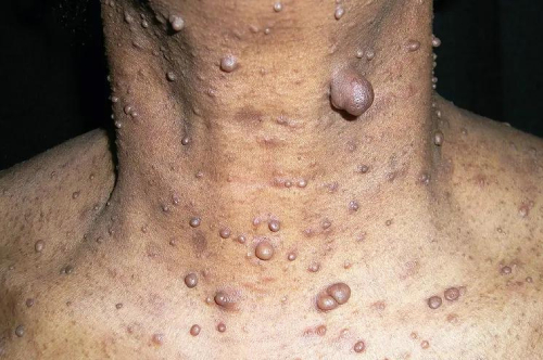 Studying-with-neurofibromatosis