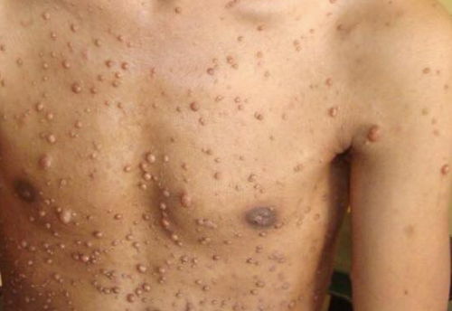 Working-with-neurofibromatosis