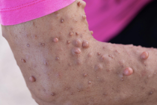 daily-life-with-neurofibromatosis