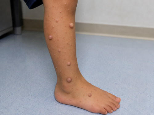 Neurofibromatosis-diagnosis