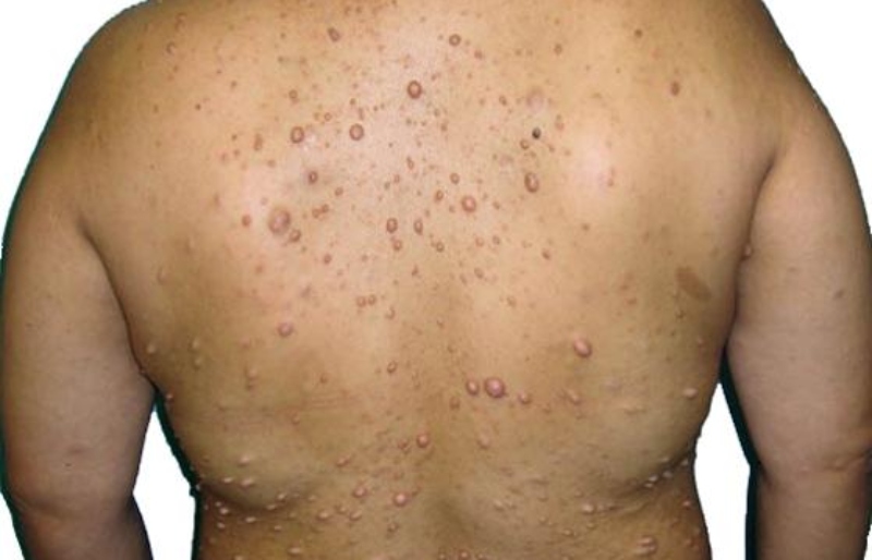 Neurofibromatosis-diagnosis