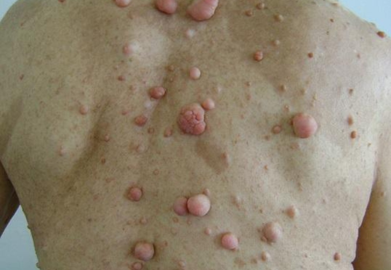 Neurofibromatosis